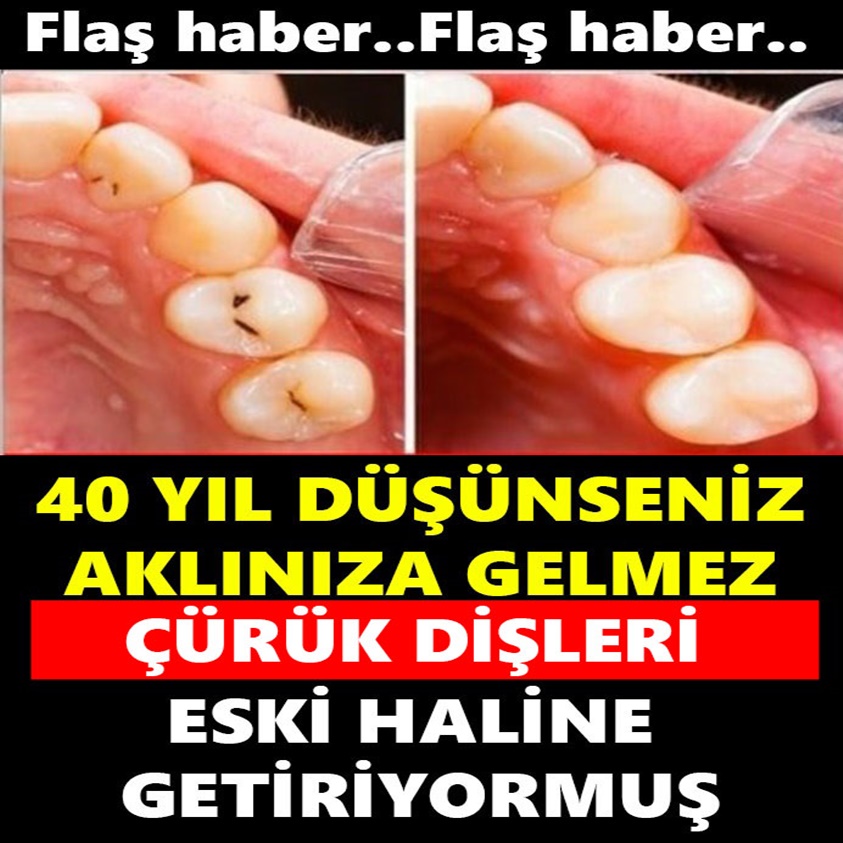 FLAŞ HABER..40 YIL DÜŞÜNSENİZ AKLINIZA GELMEZ ÇÜRÜK DİŞLERİ ESKİ HALİNE GETİRİYORMUŞ