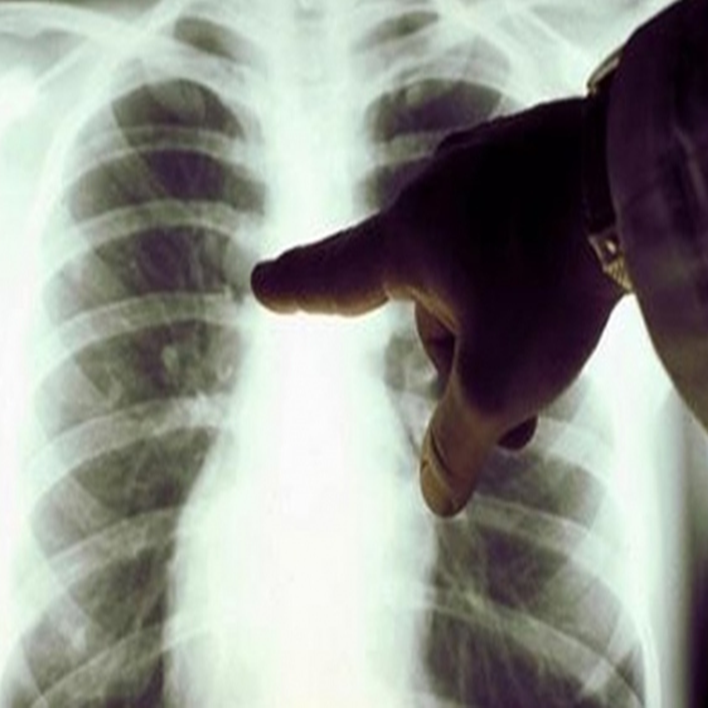 Akciğer Kanseri Ameliyatı Olan Kaç Yıl Yaşar? Kadın Hastalıkları