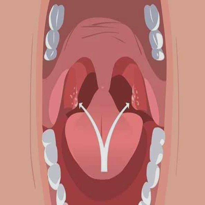akut-tonsillit-komplikasyonlari-nelerdir