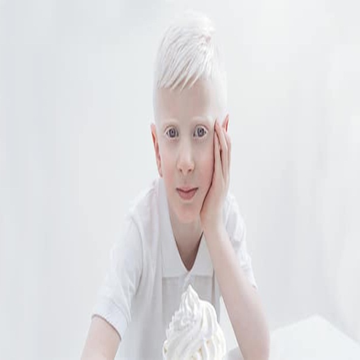 albinizm-cinsiyete-bagli-midir