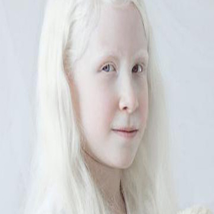 albinizm-diger-adi-nedir