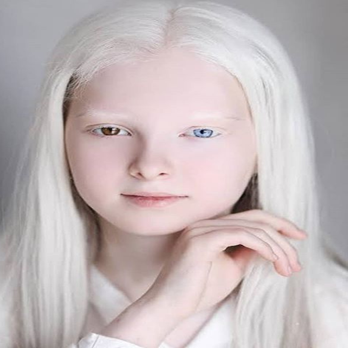 albinizm-engelli-raporu-kactir