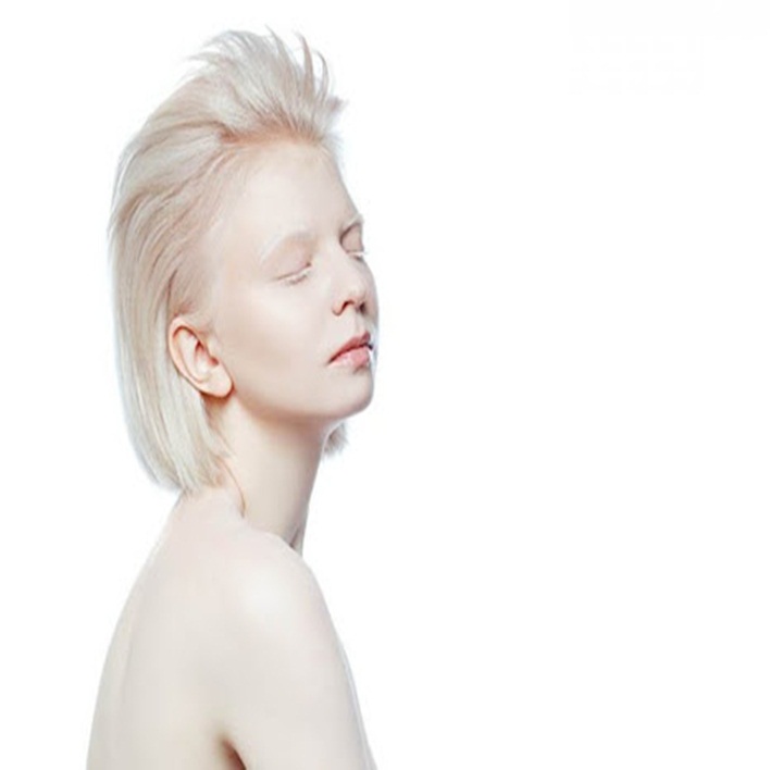 albinizm-genetik-midir