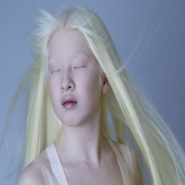 albinizm-gorme-bozukluguna-neden-olur-mu