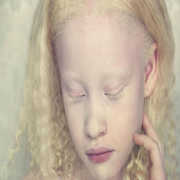 albinizm-hangi-kromozomla-tasinir