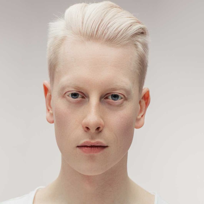 albinizm-hastaligi-nedir