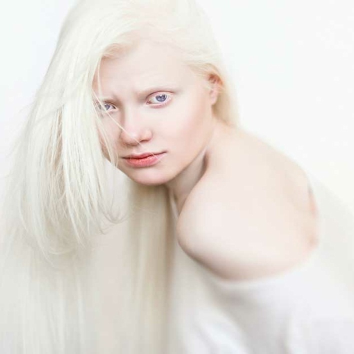 albinizm-kalitsal-hastalik-midir