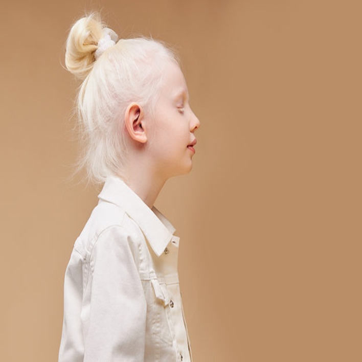 albinizm-nasil-olusur