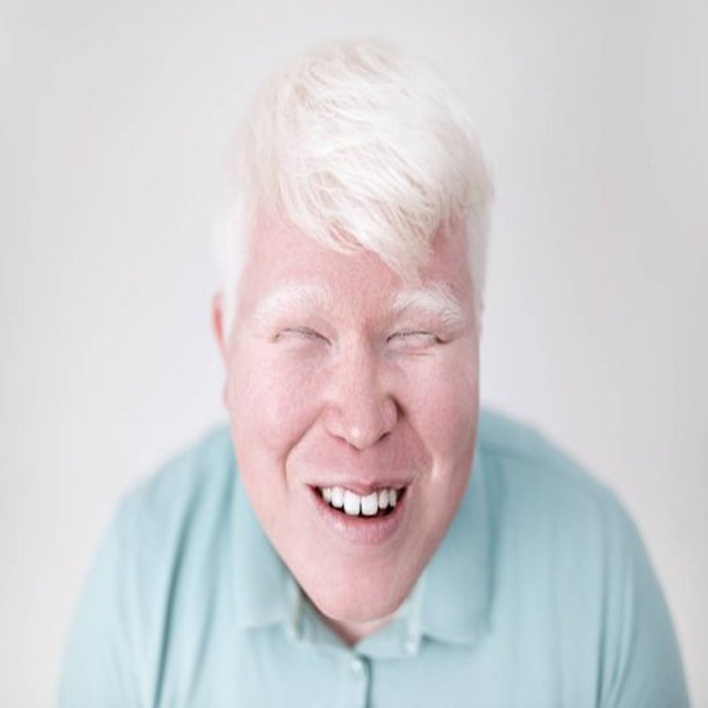 albinizm-tedavisi-var-mi