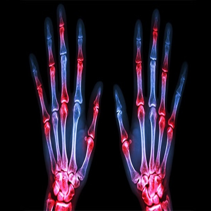 artrit-engel-orani-kactir