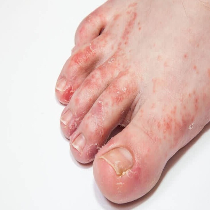 ayak-mantarinda-antibiyotik-kullanilir-mi
