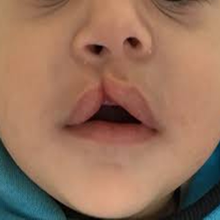 bebeklerde-dudak-yarigi-tedavisi