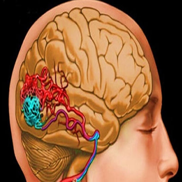 beyin kanamasi belirtileri nelerdir kadin hastaliklari