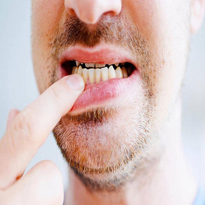Diş Eti Çekilmesi Ağrı Yapar Mı? Kadın Hastalıkları