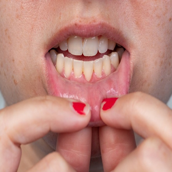 Diş Eti Çekilmesi Ağrısına Ne İyi Gelir? Kadın Hastalıkları