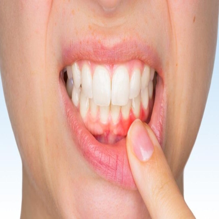 Diş Eti Çekilmesi Tedavisi Nasıldır? Kadın Hastalıkları