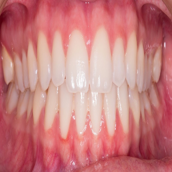 Diş Eti Şişmesi Halsizlik Yapar Mı? Kadın Hastalıkları
