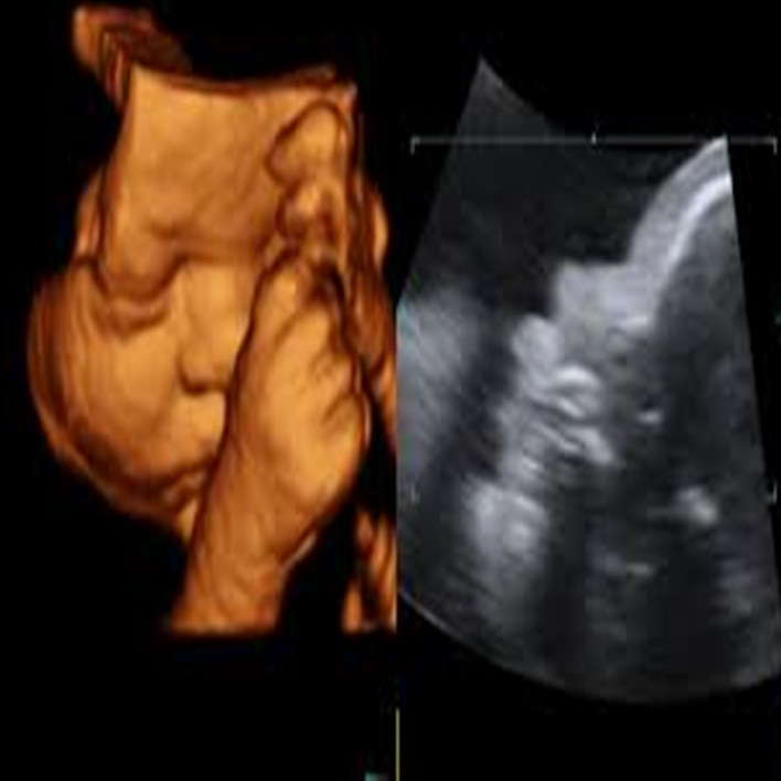 doopler-ultrasonografi-gebeligin-hangi-haftasinda-yapilir
