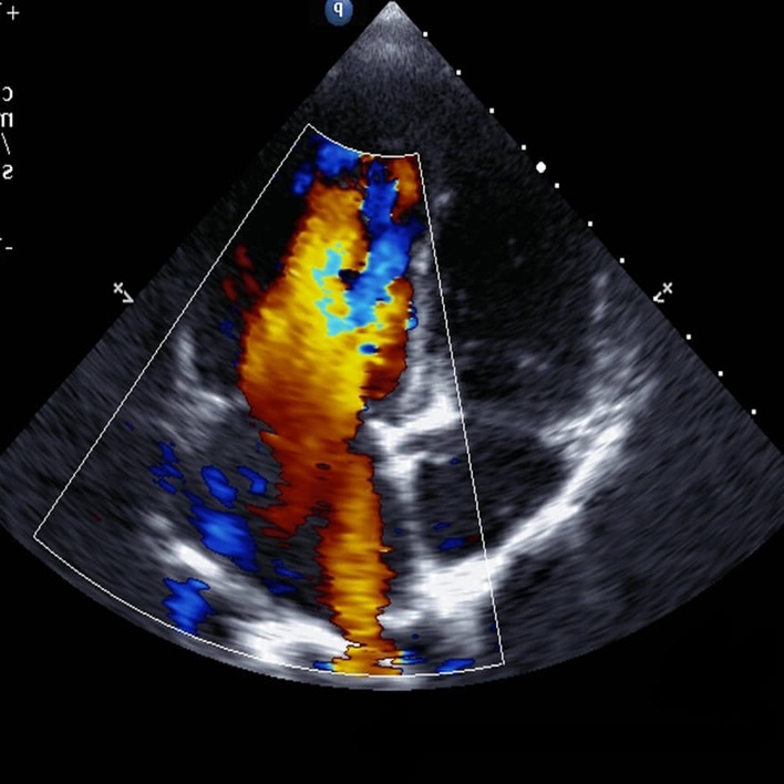 doopler-ultrasonografi-nedir