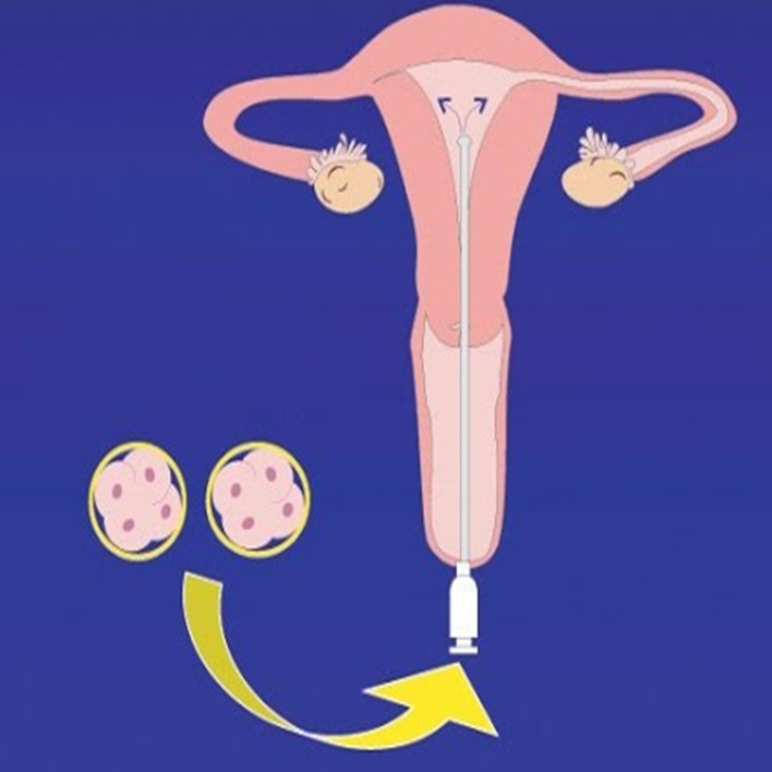 embriyo-transferi-nedir