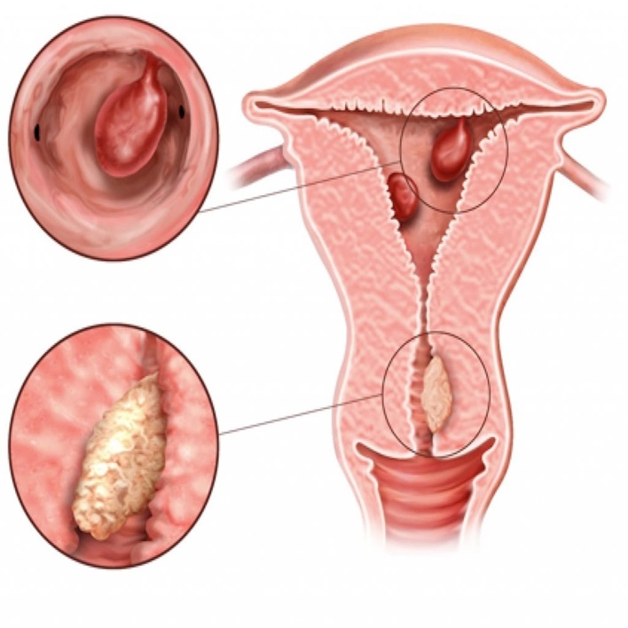 endometrial-polip-neden-olur