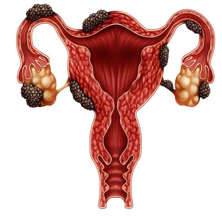 endometriozis-neden-olur