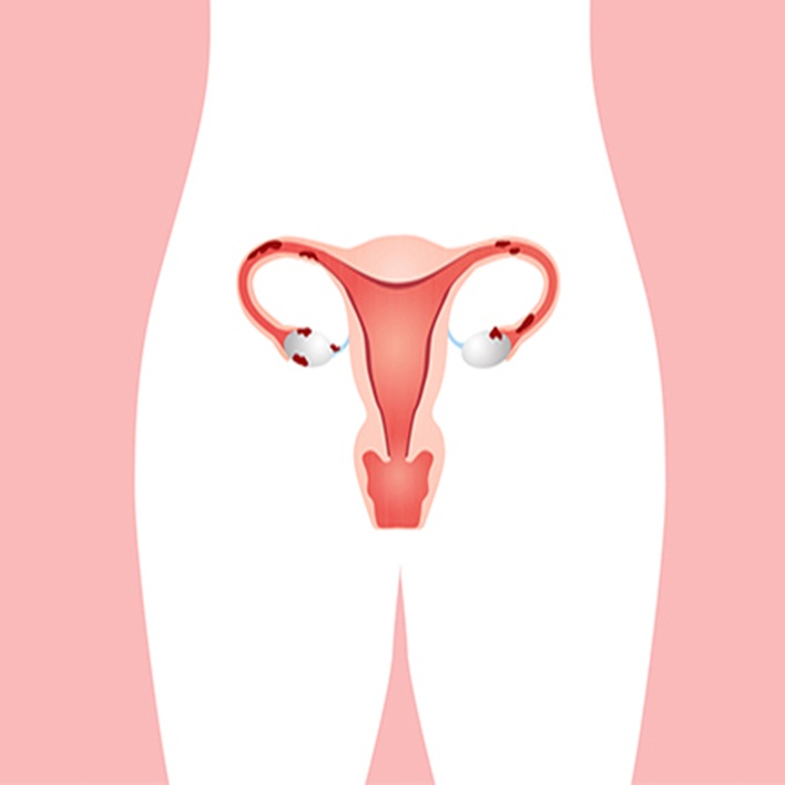 endometriozis-nedir