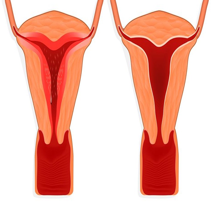 endometrit-nedenleri-nelerdir