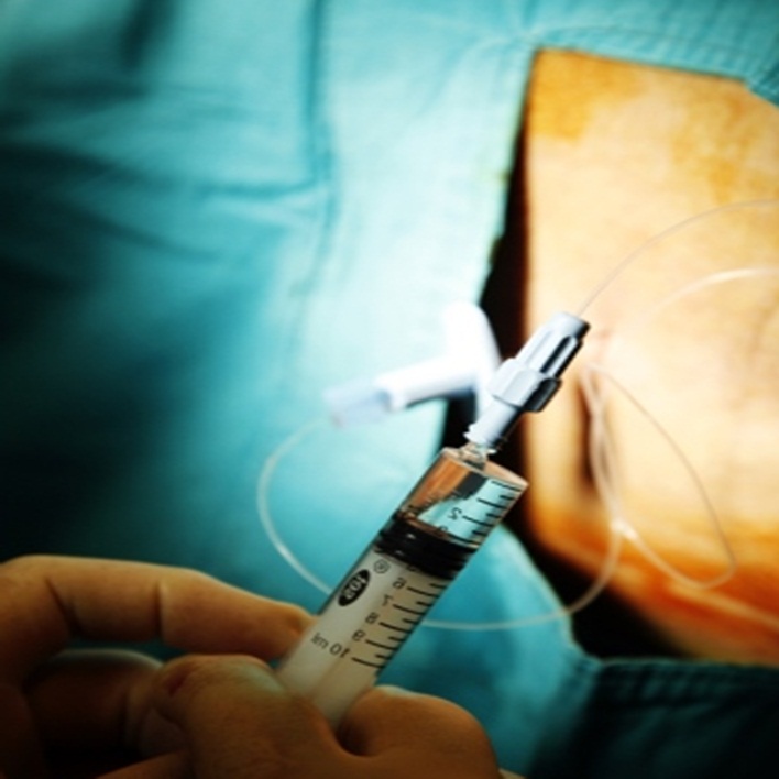 epidural-anestezi-nereden-yapilir