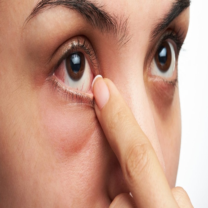 Göz Alerjisi Kaç Günde Geçer? Kadın Hastalıkları