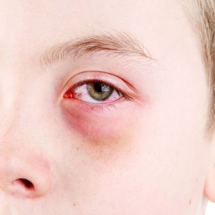 goz alerjisi nasil gecer kadin hastaliklari