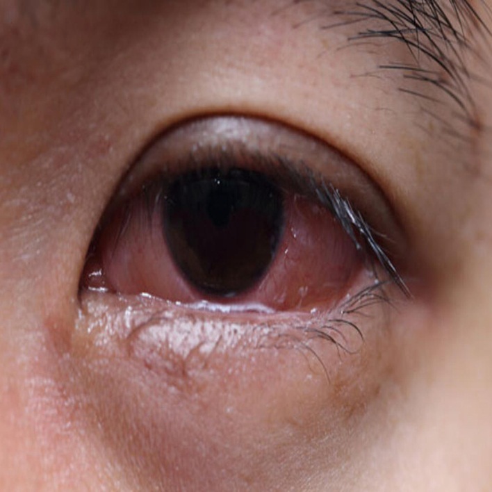 Göz Alerjisine Ne İyi Gelir? Kadın Hastalıkları