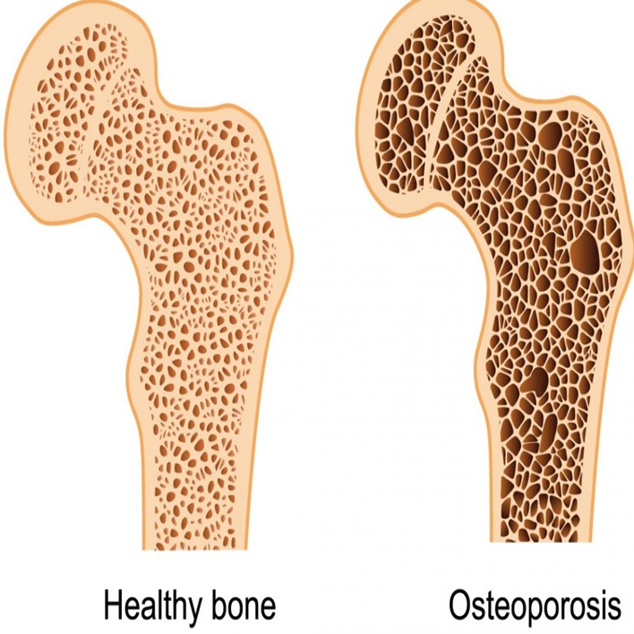 osteoporoz-belirtileri-neler
