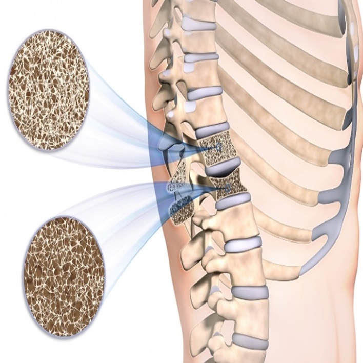 osteoporoz-en-cok-hangi-bolgede-gorulmektedir