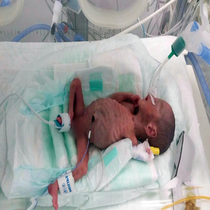 premature bebek devlet yardimi kadin hastaliklari