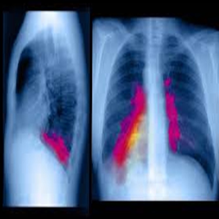 pulmoner-emboli-belirtileri-nelerdir
