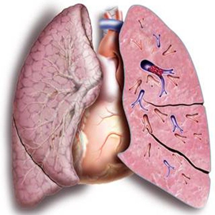 pulmoner-emboli-iyilesme-sureci-nasildir