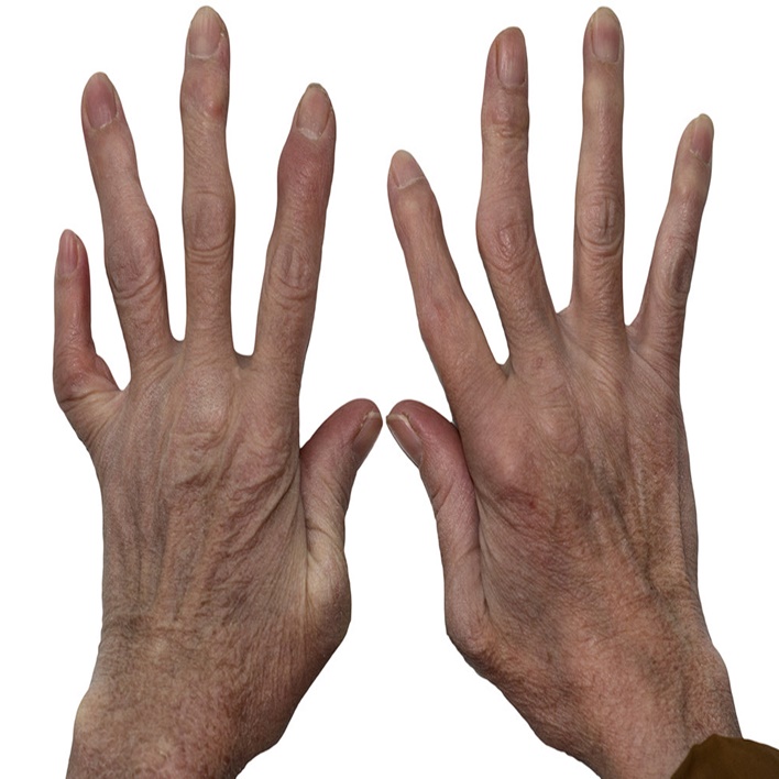 romatoid-artrit-belirtileri