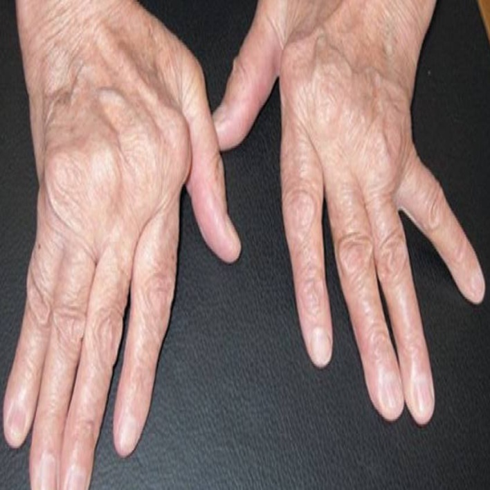 romatoid-artrit-cilt-bulgulari