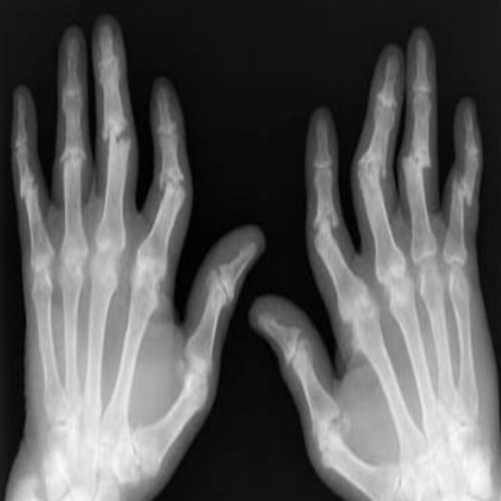 romatoid-artrit-kanda-cikar-mi
