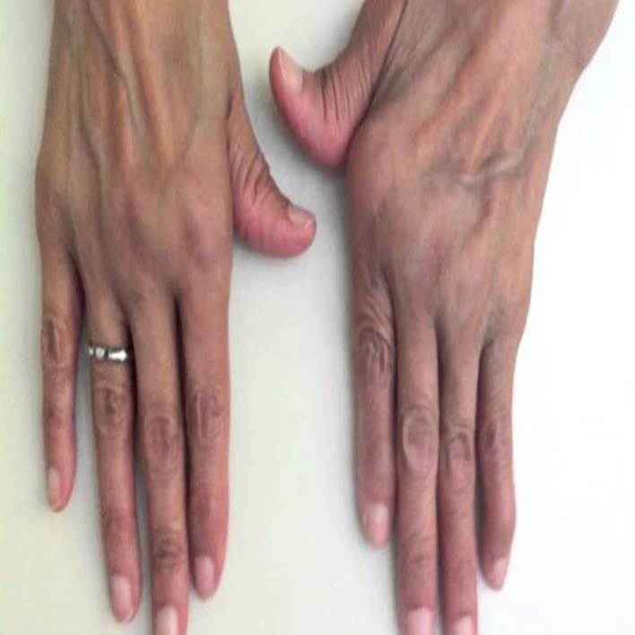 romatoid-artrit-komplikasyonlari