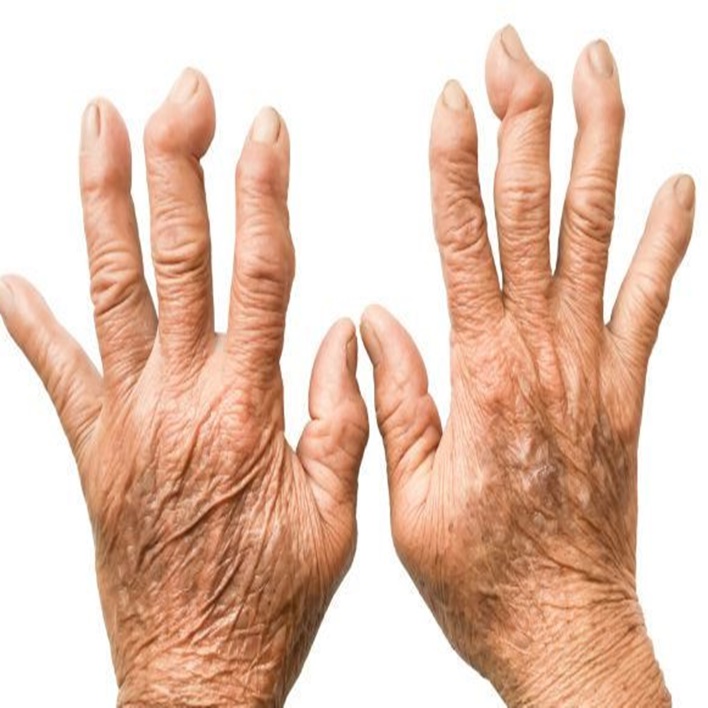 romatoid-artrite-hangi-bolum-bakar