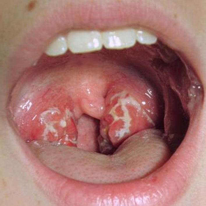 tonsillit-nedir