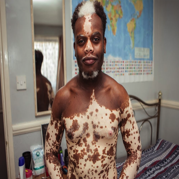 vitiligo-neden-olur