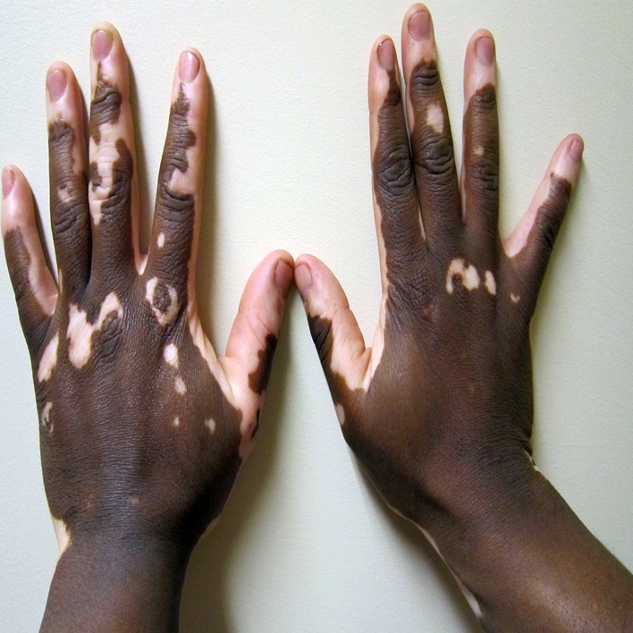vitiligo-nedir